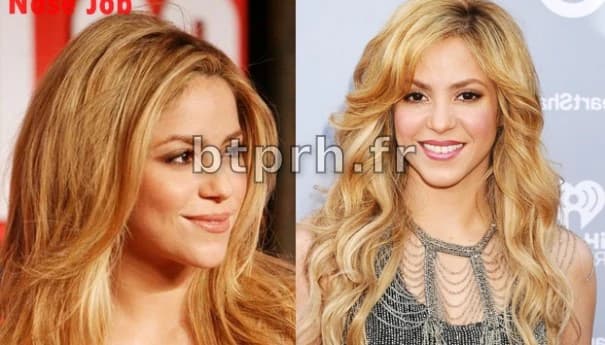 Shakira Nose Job Plastic Surgery Before And After Rhinoplasty Photos