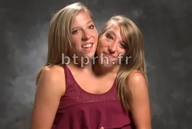 Les Sœurs Siamoises Abigail et Brittany Enceinte : Un Voyage Unique vers la Maternité